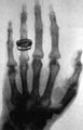 Röntgen sugárfelvétele Albert von Koelliker svájci-német orvos kezéről (kép forrása: Wikimedia Commons)