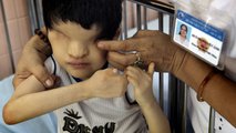 Egy szemek nélkül született vietnámi kisfiú