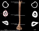 A férfi felkarcsontja nagy mértékű csontveszteséget mutat, amely jellemző a protézissel élőkre