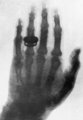 Az első röntgenfotó Anna Bertha Ludwig kezéről készült